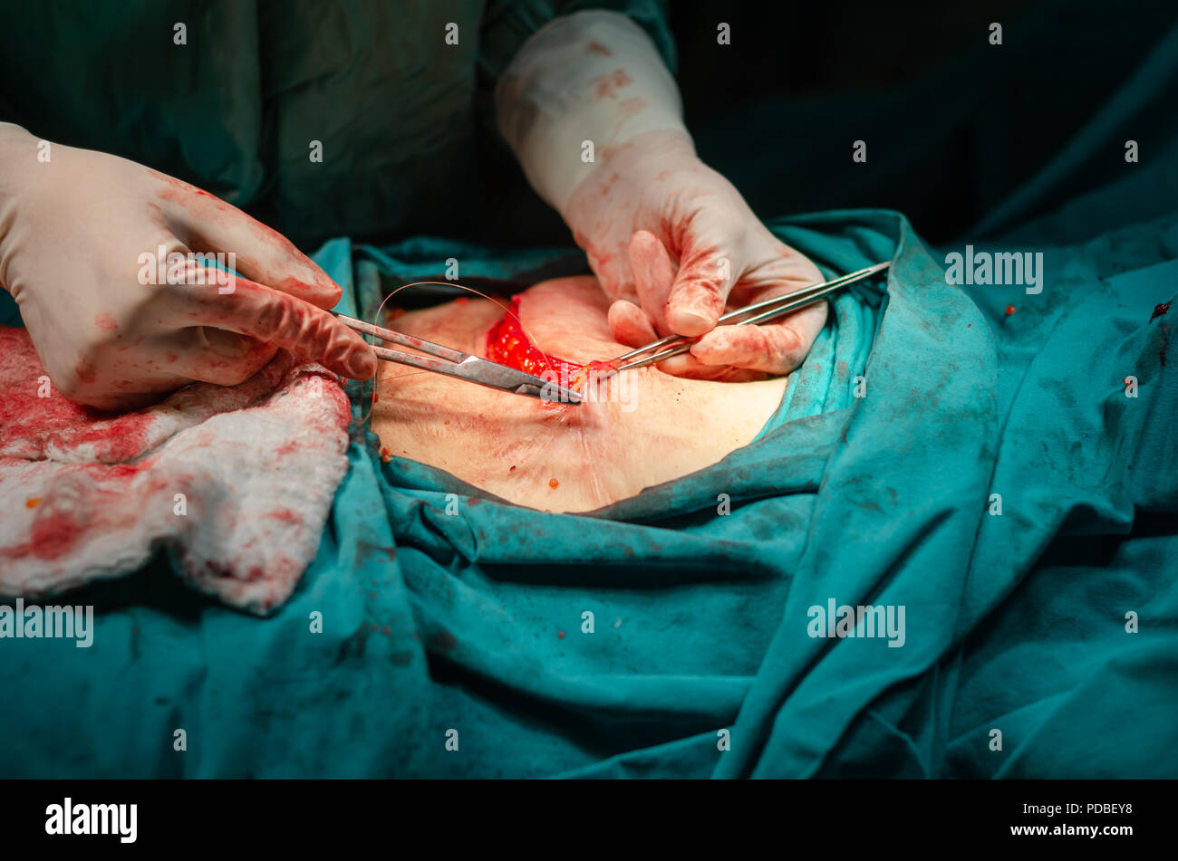 Un chirurgien est un assemblage blessure après une opération dans un hôpital Banque D'Images