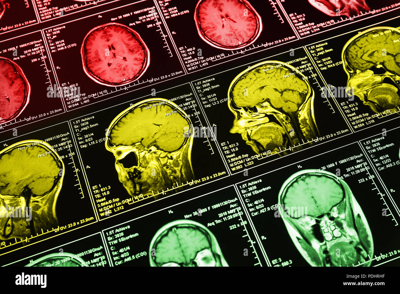 Analyse par résonance magnétique du cerveau. L'IRM scanner de la tête — free download