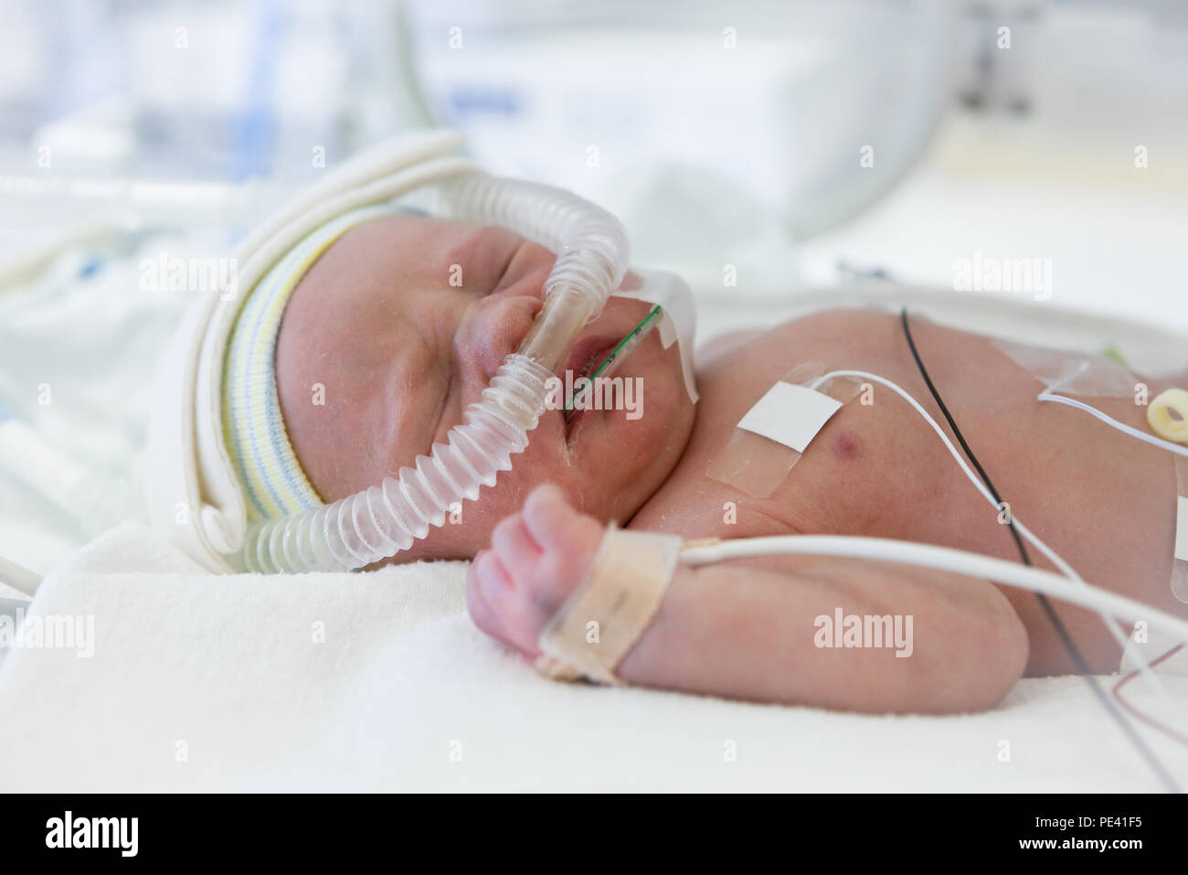Premature Baby Banque D Image Et Photos Alamy