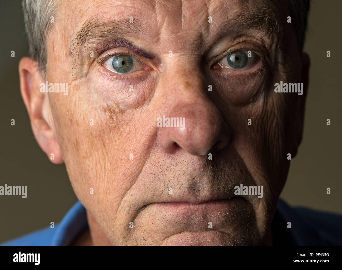 Caucasian man with a black eye Banque D'Images