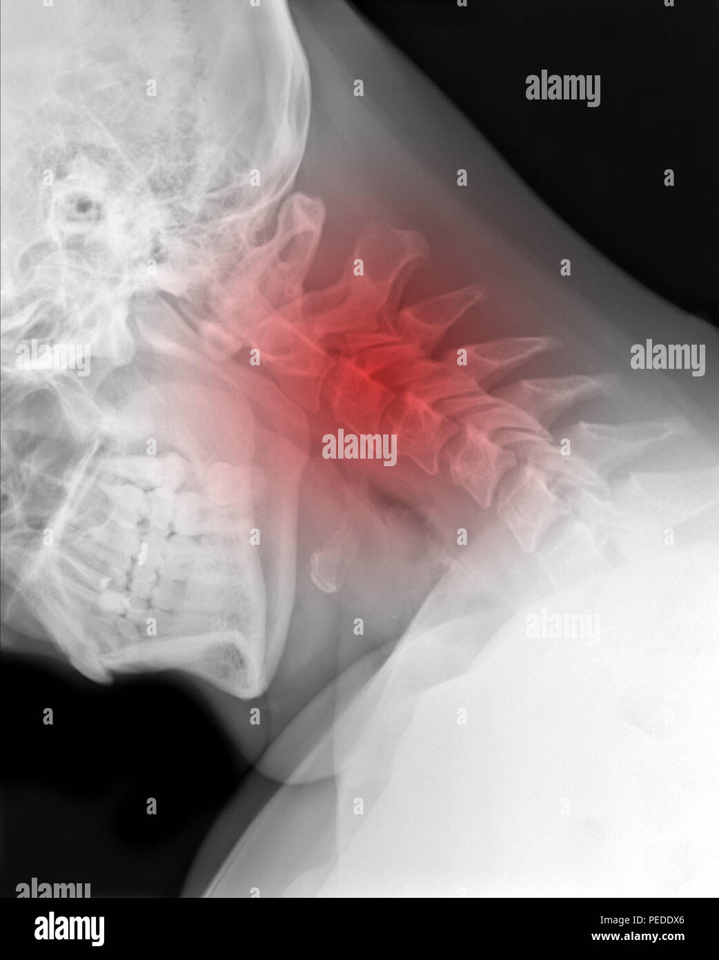 X-ray photo - rachis cervical avec symbole rouge de l'endroit douloureux Banque D'Images