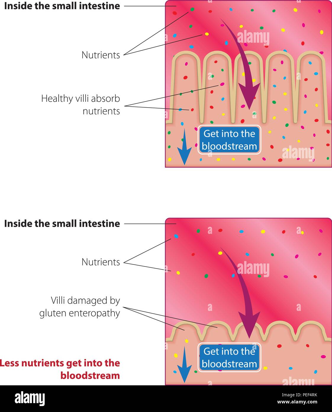 L'absorption des nutriments dans l'intestin grêle. Les villosités endommagés et en bonne santé. Vector illustration médicale Illustration de Vecteur