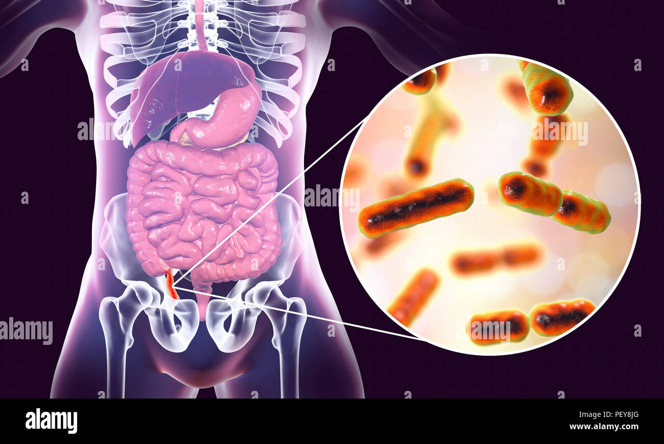 L'appendicite. Illustration d'un des droits de l'annexe, le montrant rouge et enflammée dans l'appendicite et une vue rapprochée de bactéries, les agents pathogènes de l'appendicite. Bacteroides sp. sont l'un des agents étiologiques de l'anaérobiose commun et de l'appendicite aiguë chronique. Banque D'Images