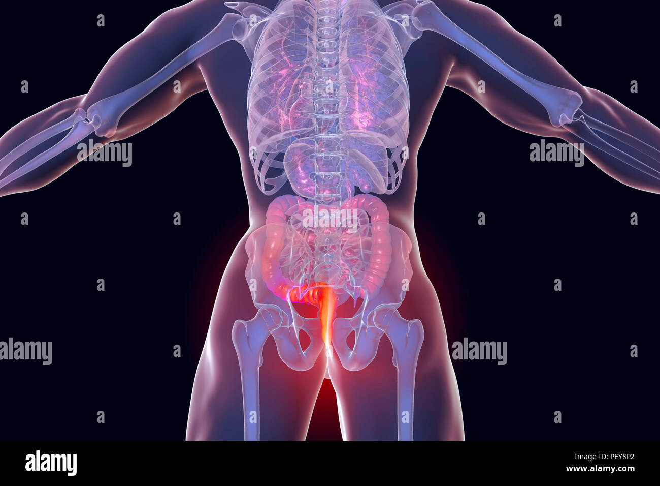 Les hémorroïdes. Illustration d'ordinateur d'une vue arrière du corps humain avec des hémorroïdes dans l'anus. Banque D'Images