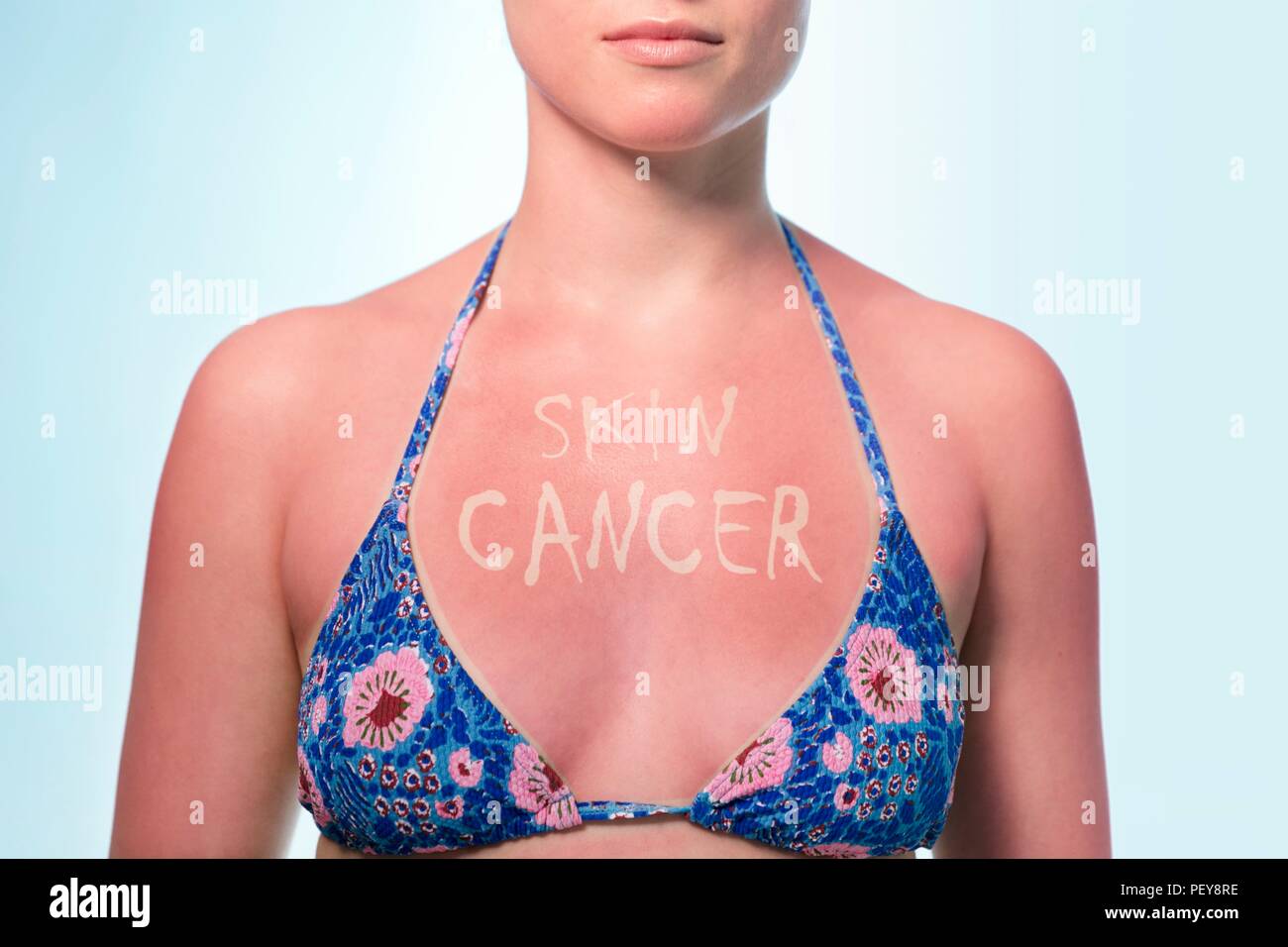 Le cancer de la peau des dommages du soleil, de l'image conceptuelle. Femme avec 'peau cancer" écrit sur sa poitrine de soleil. Banque D'Images