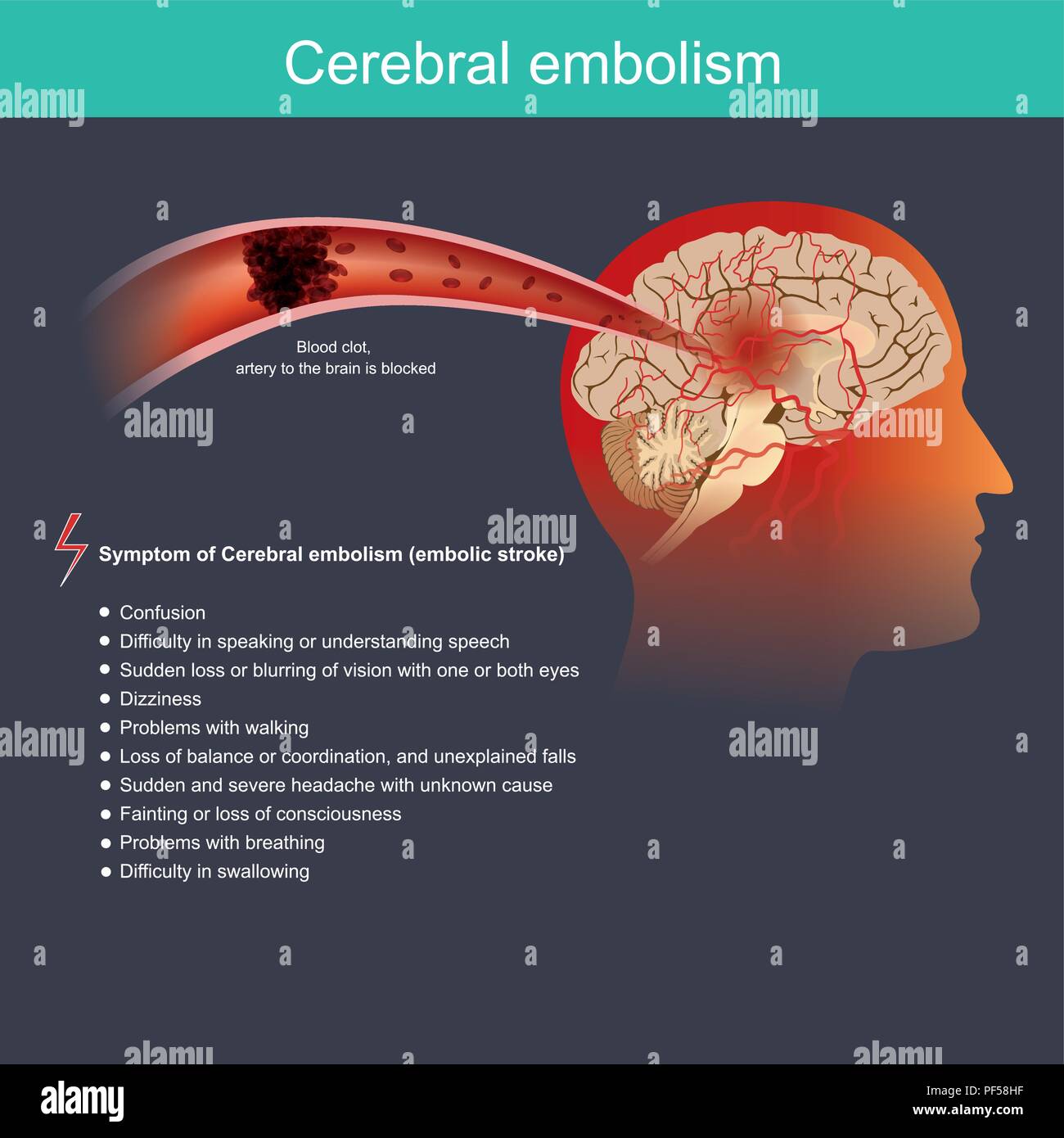Il se produit lorsqu'une particule d'une partie du corps au travers de la circulation sanguine au cerveau et bloque le flux sanguin dans une artère du cerveau Illustration de Vecteur