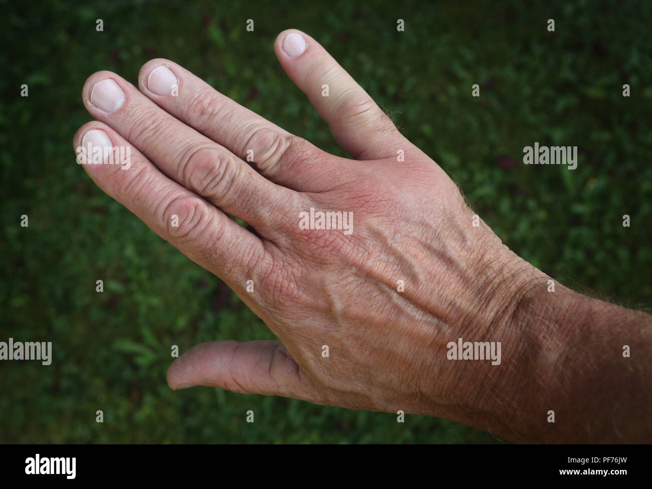 Kempten, Allemagne. 20e Août, 2018. Un petit doigt et une partie de l'arrière de la main sont enflés après une piqûre de guêpe. Credit : Karl-Josef Opim/dpa/Alamy Live News Banque D'Images