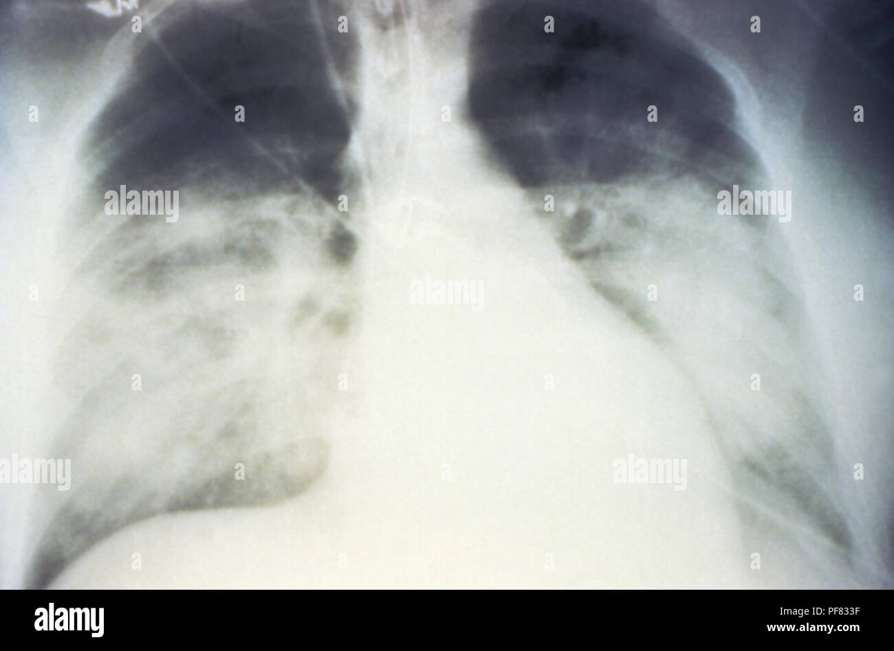 Mise en scène mi-épanchement pulmonaire bilatéral en raison de syndrome pulmonaire à hantavirus (SPH), révélée dans l'AP La radiographie du thorax, 1994. Image courtoisie Centres for Disease Control (CDC) / D. Loren Ketai, M.D. () Banque D'Images