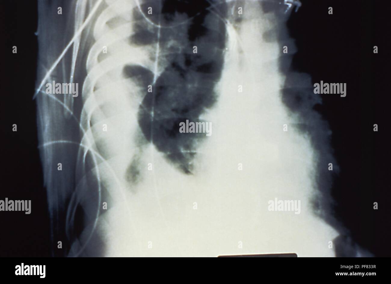 Grand épanchement pulmonaire en raison de syndrome pulmonaire à hantavirus (SPH), révélé dans le thorax en décubitus latéral x-ray, 1994. Image courtoisie Centres for Disease Control (CDC) / D. Loren Ketai, M.D. () Banque D'Images