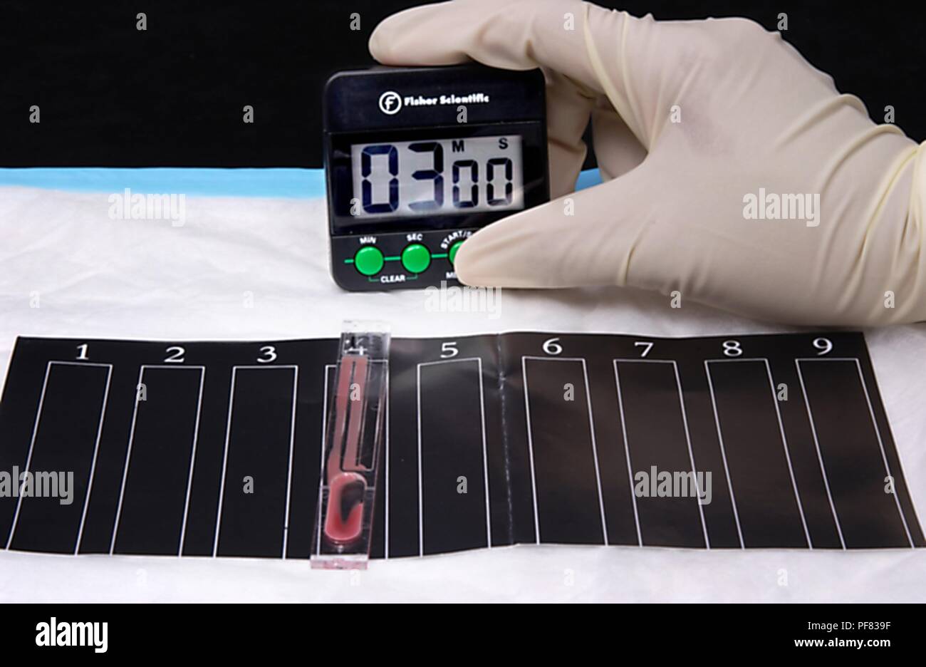 Capillus VIH-1/Test Rapide VIH-2 Mélange de spécimen de réactif et de voyager le long du canal capillaire dans la fenêtre de visualisation, 2004. Image courtoisie Centres for Disease Control (CDC) / Cheryl Tryon, Stacy Howard. () Banque D'Images Capillus VIH-1/Test Rapide VIH-2 Mélange de spécimen de réactif et de voyager le long du canal capillaire dans la fenêtre de visualisation, 2004. Image courtoisie Centres for Disease Control (CDC) / Cheryl Tryon, Stacy Howard. () Banque D'Images