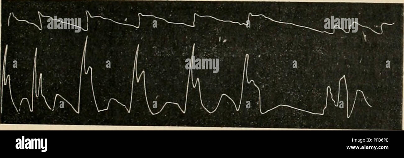 . Dictionnaire de physiologie. La physiologie. CÅUR. 3il encore une expérience qui dOniontre pleinement que la théorie soutenue pai' Biuir.KE est de tous points irrecevable. Si l'on injecte l'aorte par la veine pulmonaire, sur la réussit â remplir les artères coronaires, quoi(iue les l'alvules¯moà sij;des aient été relevées par le passage de l'injection. De son cÃ'té F.ndem.en.n prouve sur le cÅur séparé du corps, que, lorsqu'on remplit cet organe d'un liquide et qu'on simule les mouvements des ventricules, ces mouvements se traduisent par des oscillations du mÃ'me ordre dans la colonne de Banque D'Images