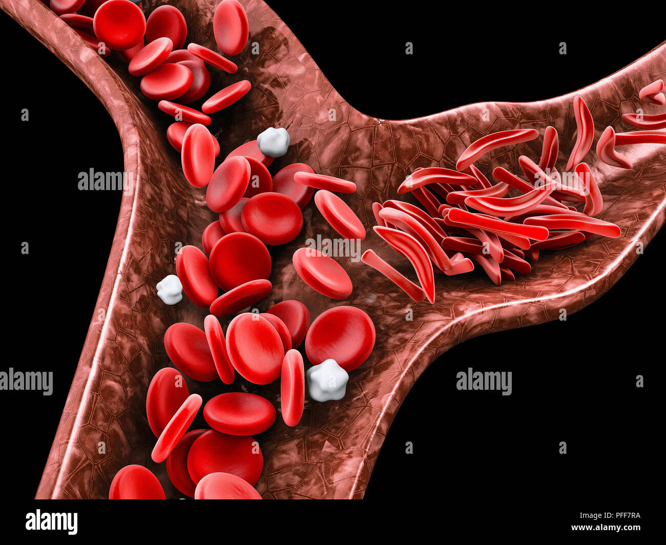 L'anémie de cellules de faucille, 3D illustration du vaisseau sanguin normal et déformés avec Crescent Banque D'Images
