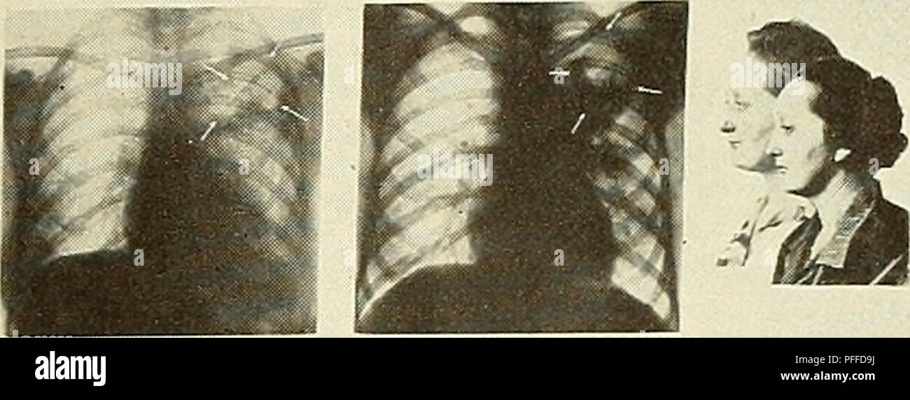 . Une décennie de progrès dans l'eugénisme ; documents scientifiques du troisième congrès international d'eugénisme, tenue au Musée Américain d'histoire naturelle, New York, août 21-23, 1932 ... Commission de publication, Harry F. Perkins, président ... Harry H. Laughlin, secrétaire. L'eugénisme. SNJTiTUT ANTHROPOIOGIE WIIHEIM urnes fourrure MEWOillCHE ERBLEHRIUNDEUGENIK ZWiaiNGE BERLIN TWINS ll((l KMiiR WILHELNf MENfCHLICHE INiTITUT ANTHROPOIOGIE ERBLEHRE UND FOURRURE EUGENIKBERLIN lLLIMeiE TUBERKUIOSE-'ZVs-jumeaux. EINEIIGE ZWILIINGE-SEIT 91AHREN GETRENNT 05TPREUSSEN ERKRANKUNS BERLIN -GL£ICKZE tCPROZESS !TI6 -SEHR AHNLICH  + Banque D'Images