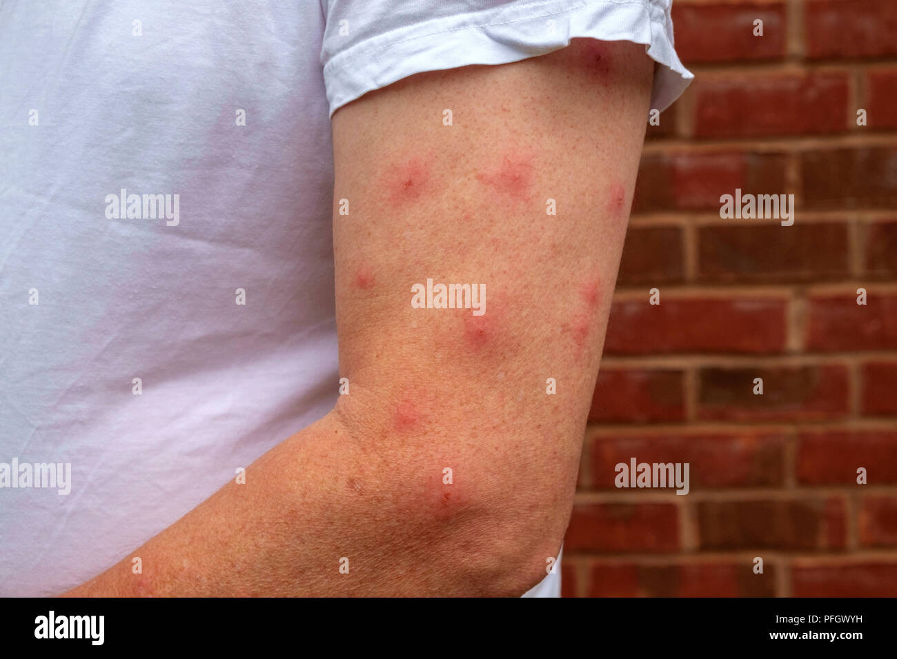 Un Homme Mur Vetu D Un T Shirt Affiche Une Forte Reaction A La Piqure De Moustique Sur Son Bras Nu Photo Stock Alamy