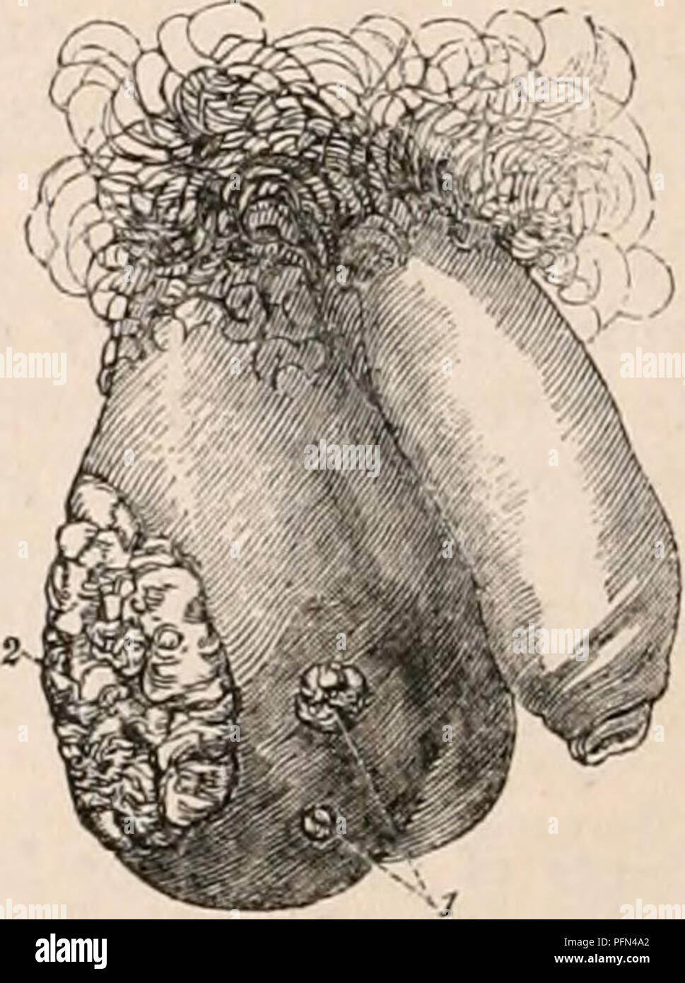 . La cyclopaedia d'anatomie et physiologie. Anatomie ; physiologie ; Zoologie. d'un homme noir, affecté à l'éléphantiasis, tiré de l'œuvre de M. Titley sur » Maladies des organes génitaux, dans l'homme," la tumeur de- gravi presque à la cheville. L'éléphantiasis du scrotum est une affection morbide des téguments, analogue à l'élargissement des extrémités communément connus sous le nom d'Barbadues ; avec la jambe qui, en effet, dans les pays où la maladie est répandue, il est susceptible d'être combiné. L'éléphantiasis du scrotum, cependant, se développe à une plus grande taille et plus rapide rend Banque D'Images