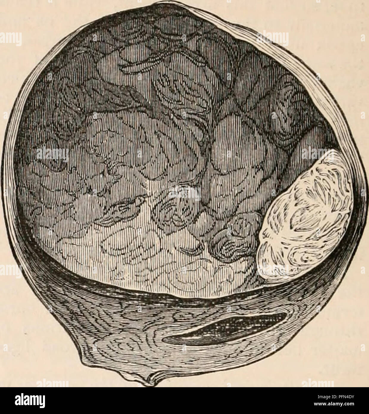 . La cyclopaedia d'anatomie et physiologie. Anatomie ; physiologie ; Zoologie. L'article de tumeurs fibromes de l'utérus. (Ad nat.) Les variations de structure observable dans les fibromes de l'utérus, dépendent principalement sur les particularités dans l'arrangement de ces éléments. Dans les formations plus dense, le blanc brillant des bandes fibreuses contenant peu de granulés le browner sub- stance, forme de nombreuses petites masses compactes, qui sont encore étroitement unis ensemble par un looser un peu du tissu fibreux qui permet de combiner l'ensemble des lobes ou lobules, va- rying en taille d'un pois à celle d Banque D'Images