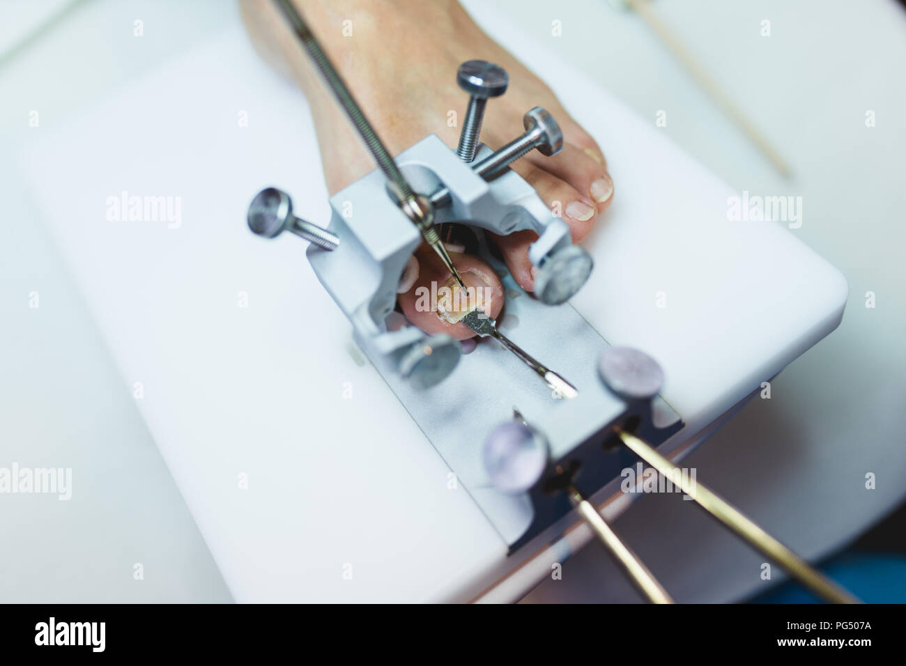 Le mycète d'un traitement par laser à pied ongle laser therapy clinic. Banque D'Images