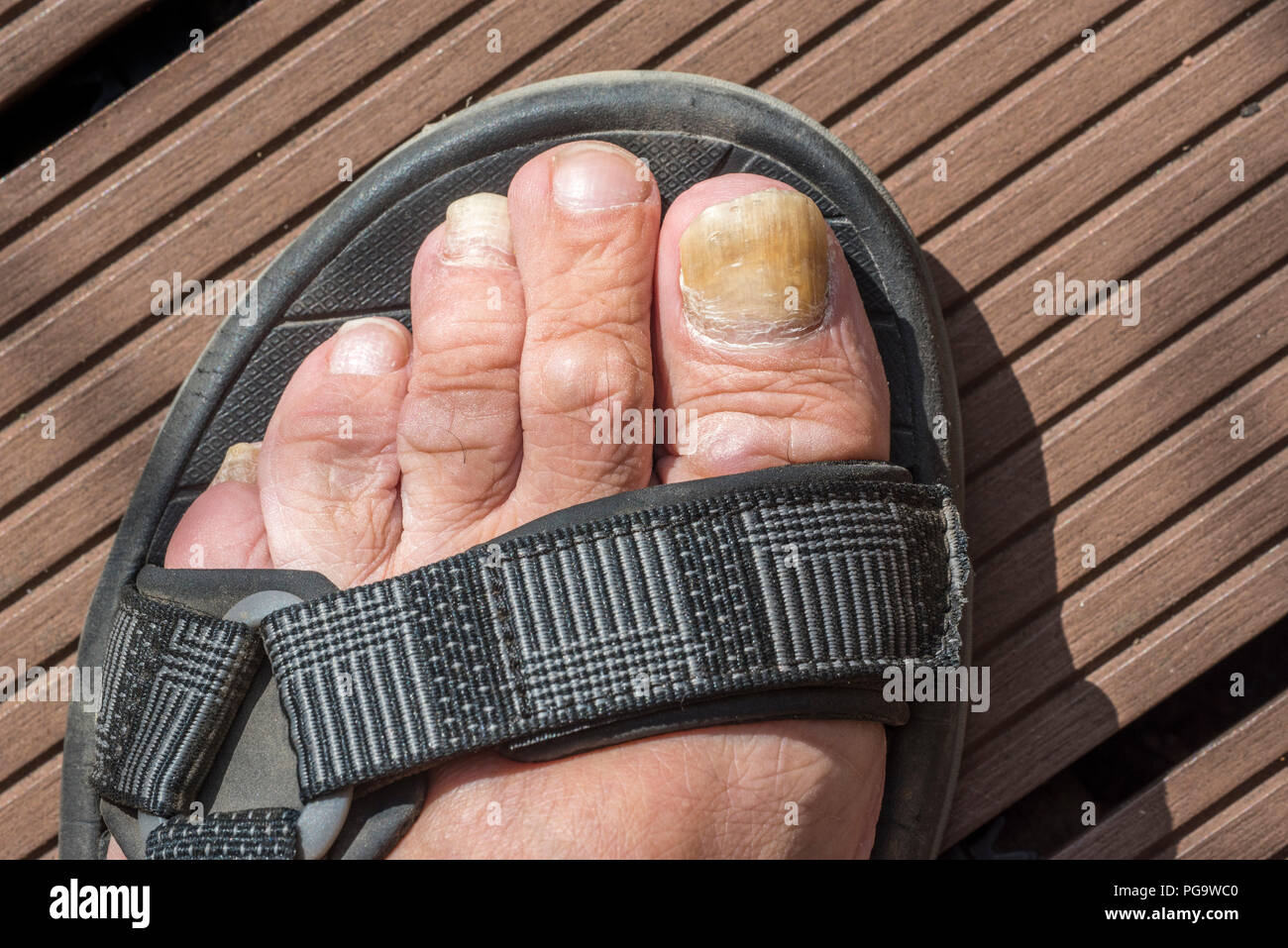 Au pied sandale montrant l'onychomycose / TINEA UNGUIUM, l'infection fongique des ongles d'orteil / Banque D'Images