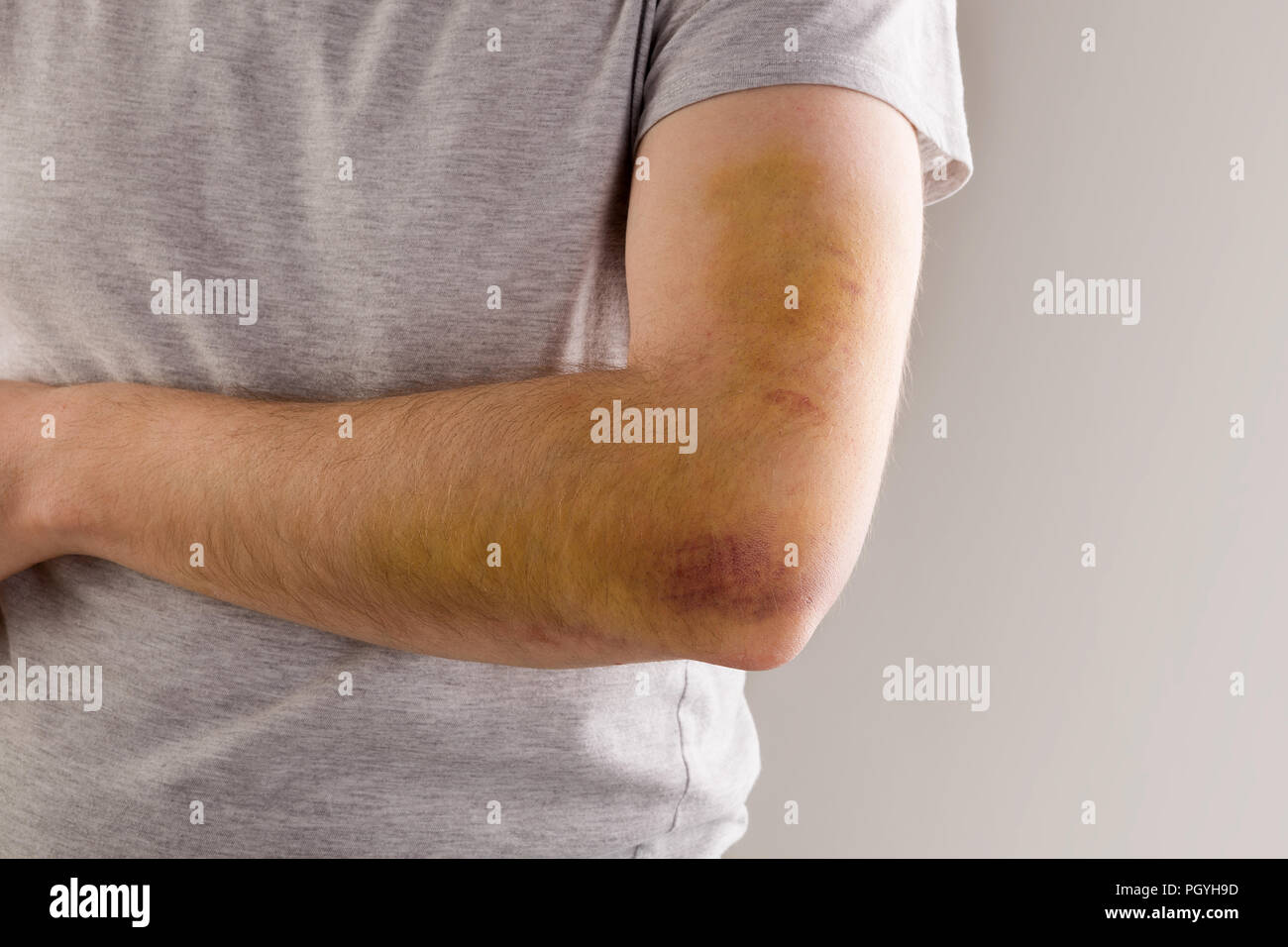 Bel homme avec de gros bleu sur l'avant-bras, le coude et le bras.  Blessures sportives Photo Stock - Alamy