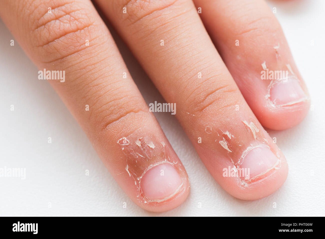 Eczéma de contact Banque de photographies et d’images à haute ...