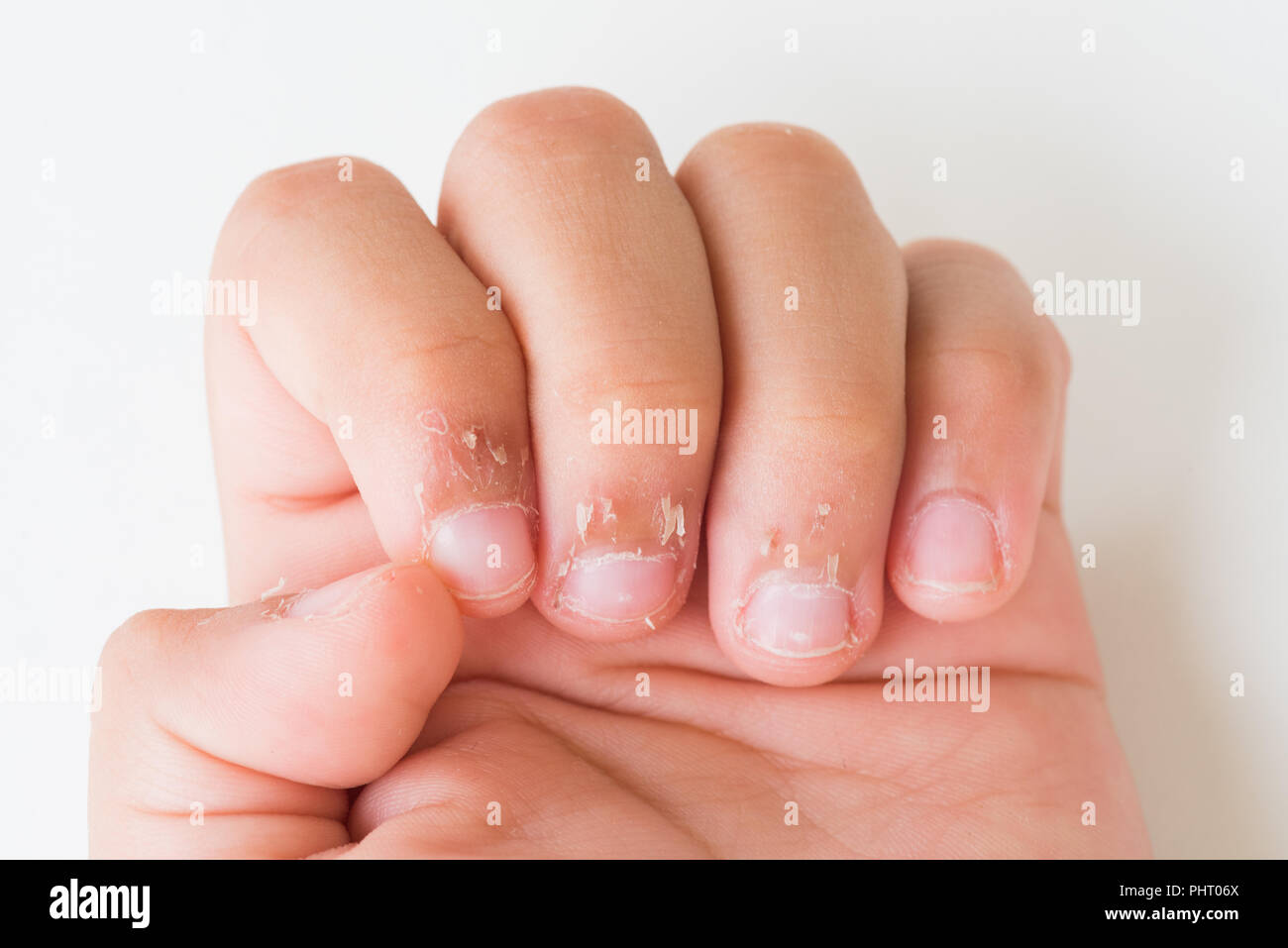 Les doigts de l'enfant de près avec la peau sèche, l'Eczéma dermatite ...