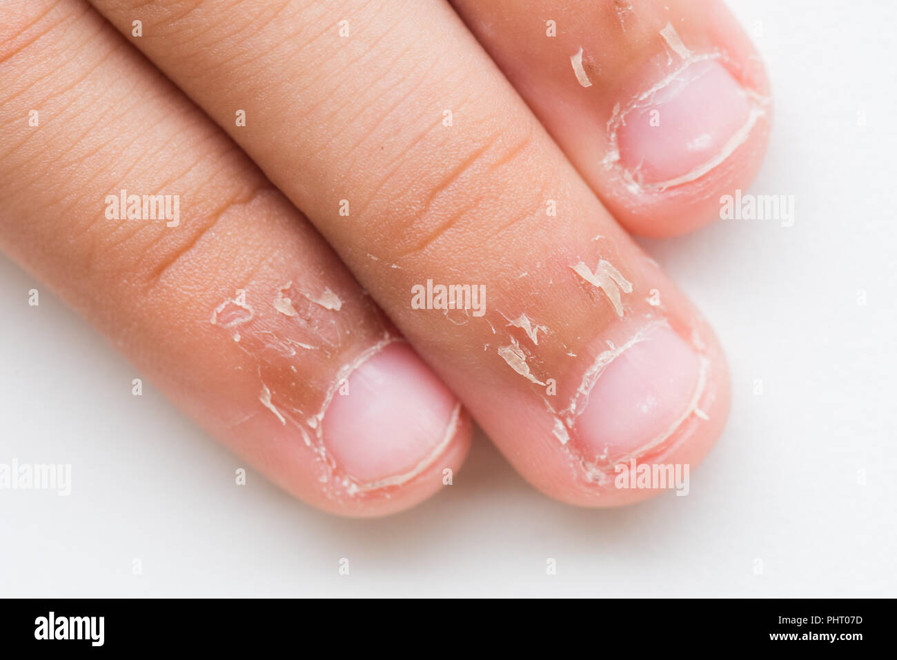 Les doigts de l'enfant de près avec la peau sèche, l'Eczéma dermatite. La médecine et les soins de concept. Banque D'Images