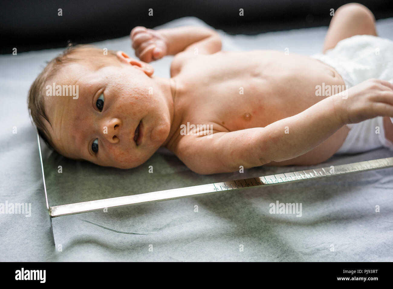 Eczema Baby Banque D Image Et Photos Alamy