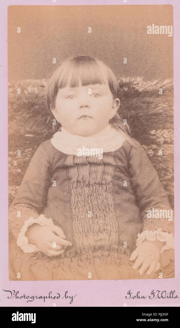 London CDV (carte de visite) d'un enfant de l'époque victorienne. Post Mortem Photographie d'une jolie fille dans sa robe. Visible à l'assemblage de la bouche. Banque D'Images