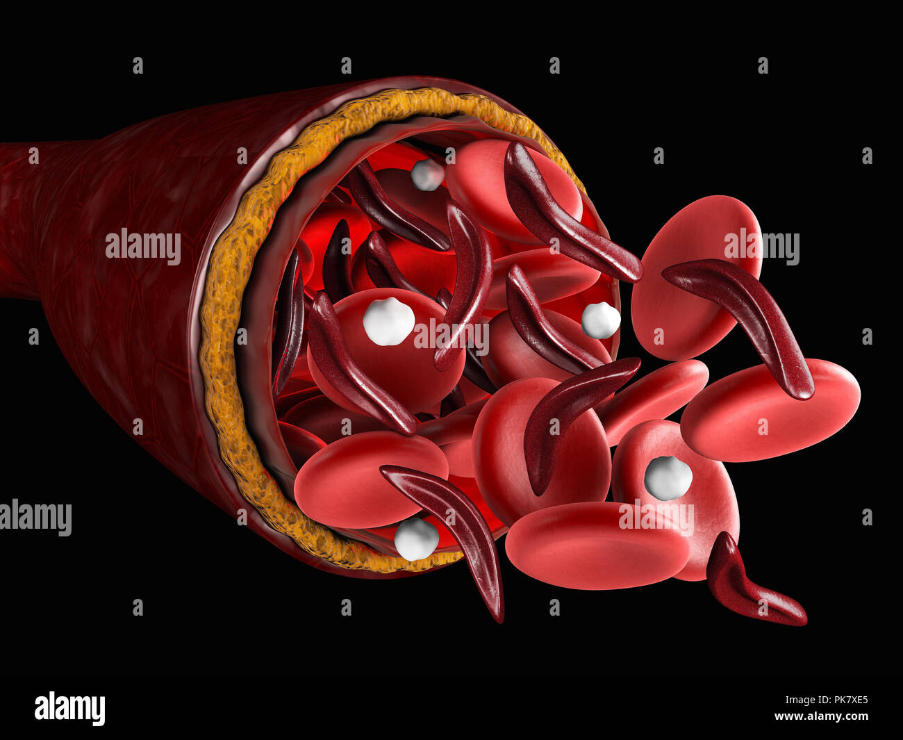 La différence des globules rouges normaux et la drépanocytose, 3d illustration sur medical Banque D'Images