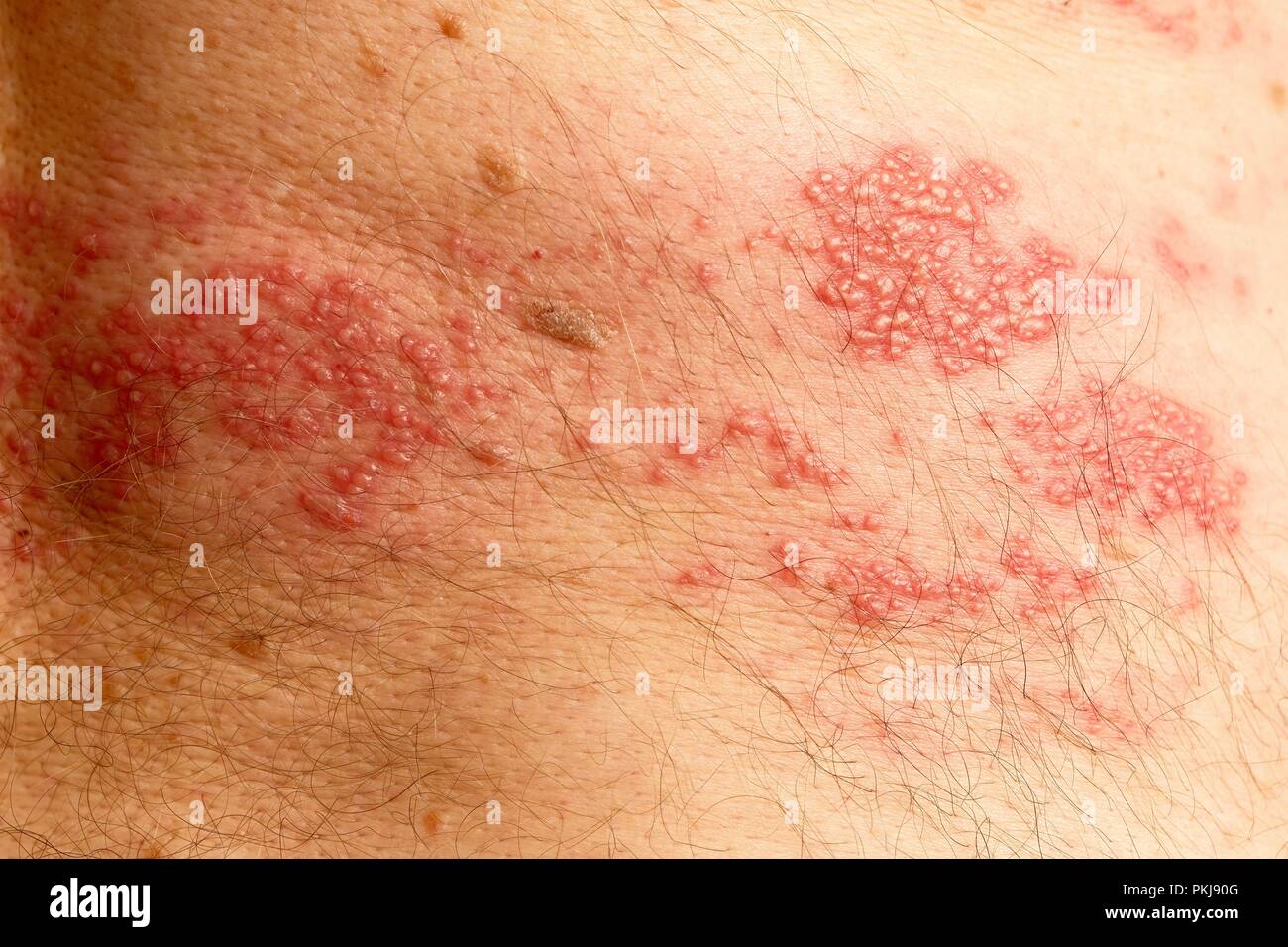 Plus de 50 ans homme montrant le classique d'éruptions cutanées associées à des bardeaux, à partir de la colonne vertébrale et s'étendant sur un côté du corps seulement. Banque D'Images Plus de 50 ans homme montrant le classique d'éruptions cutanées associées à des bardeaux, à partir de la colonne vertébrale et s'étendant sur un côté du corps seulement. Banque D'Images