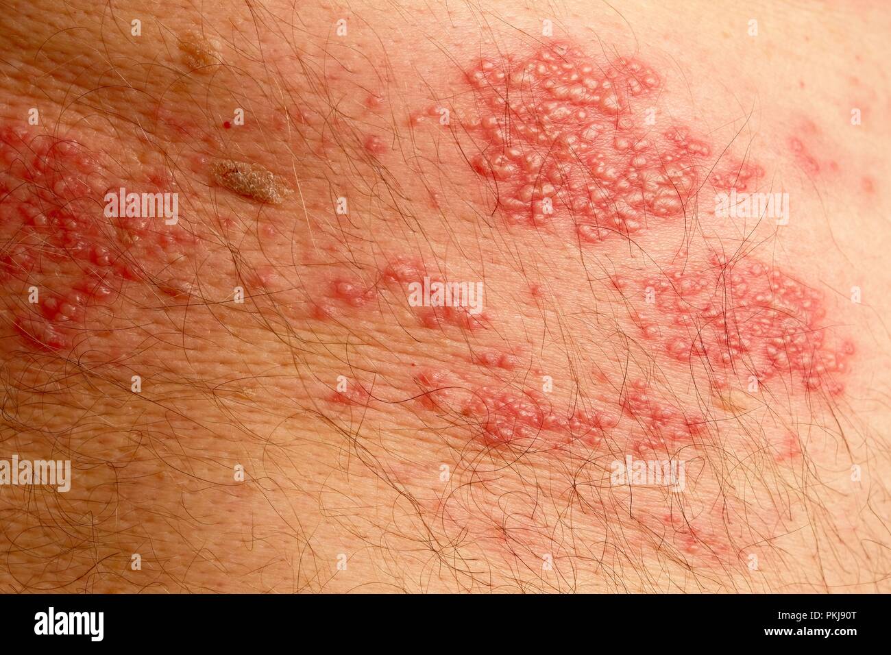 Plus de 50 ans homme montrant le classique d'éruptions cutanées associées à des bardeaux, à partir de la colonne vertébrale et s'étendant sur un côté du corps seulement. Banque D'Images Plus de 50 ans homme montrant le classique d'éruptions cutanées associées à des bardeaux, à partir de la colonne vertébrale et s'étendant sur un côté du corps seulement. Banque D'Images