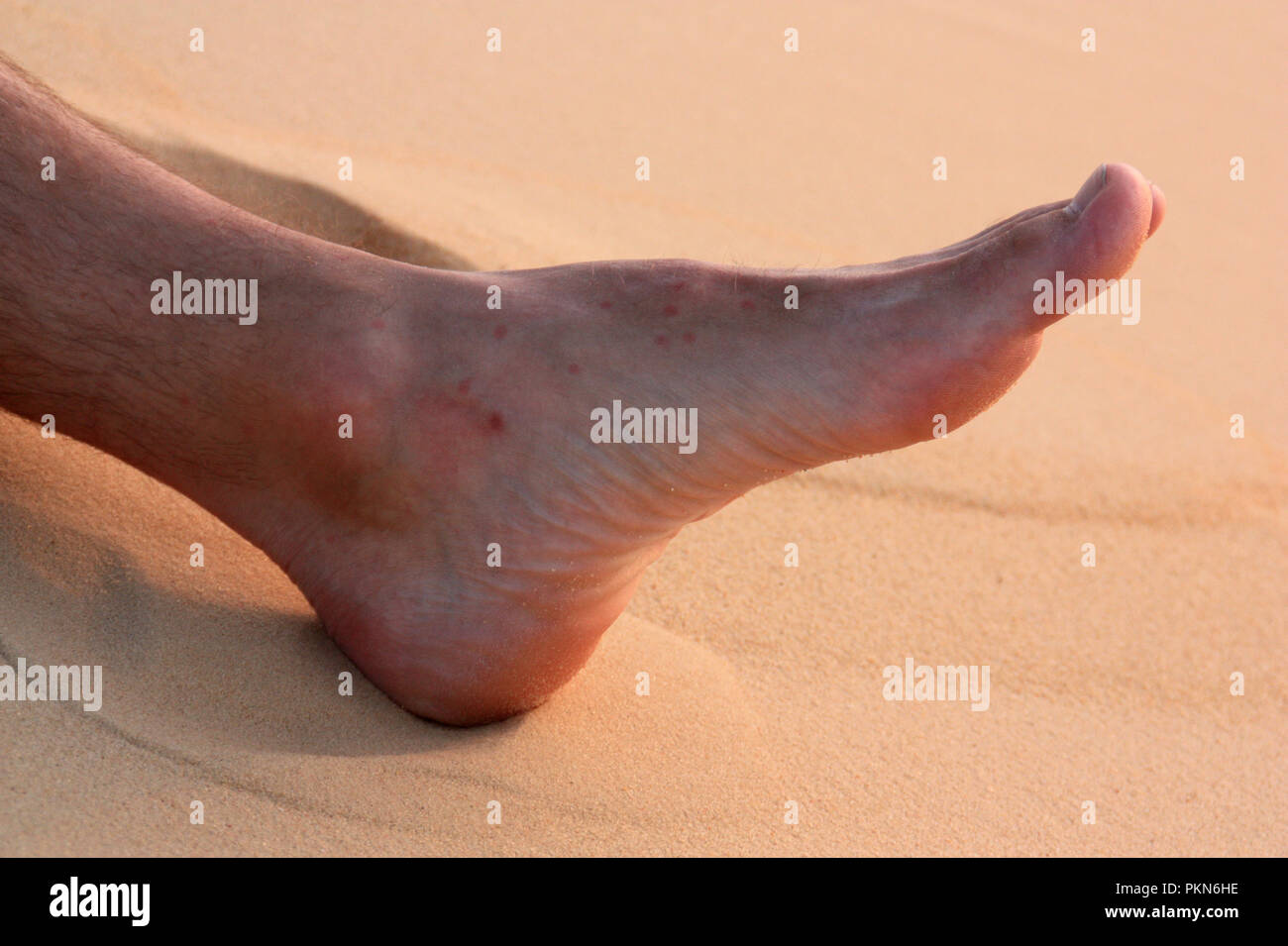 Piqûre De Puce Photos Piqûre De Puce Images Alamy