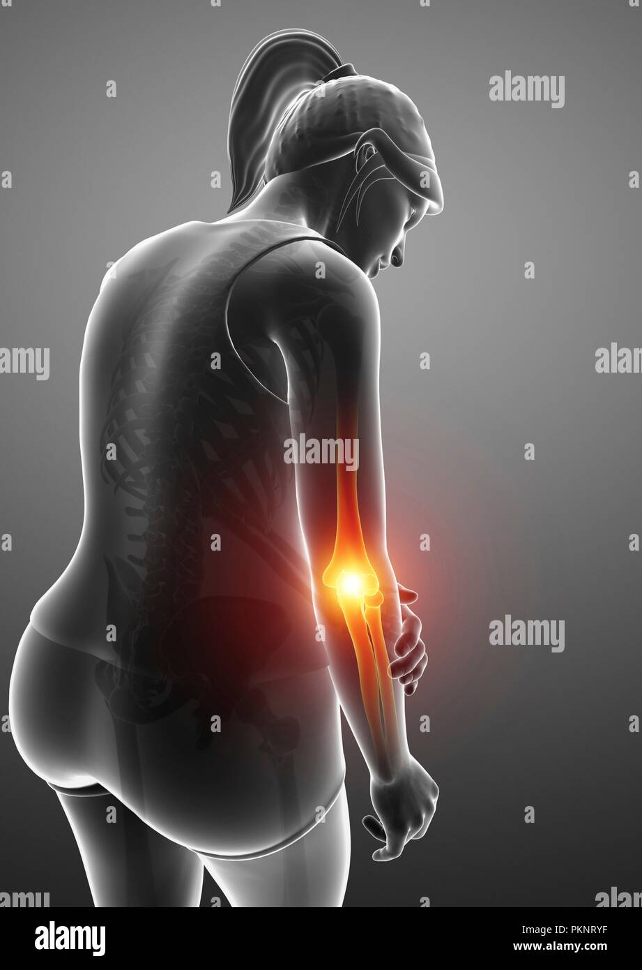 Femme avec la douleur du coude, illustration de l'ordinateur. Banque D'Images