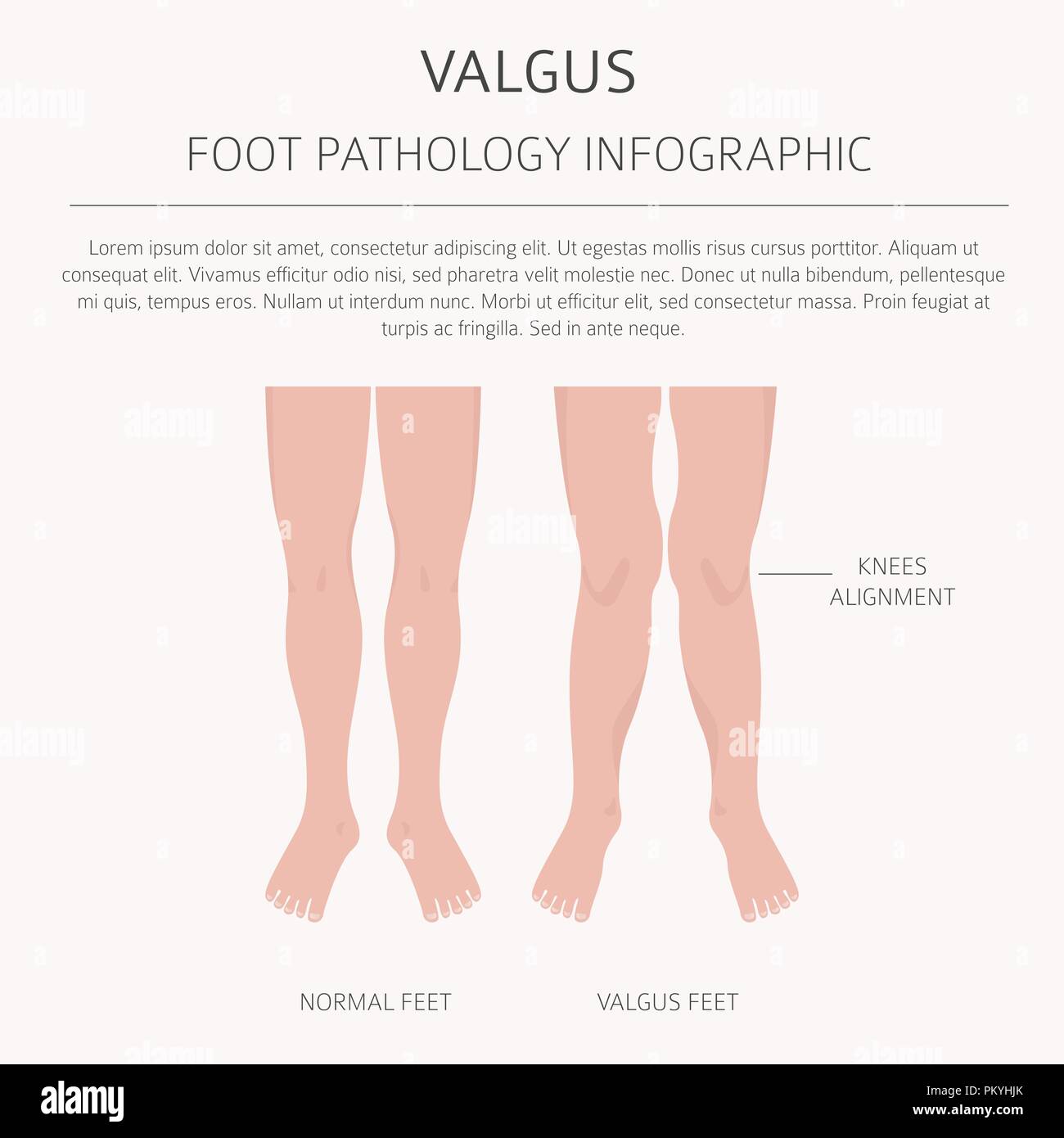 La déformation du pied en tant que maladie médicale infographie. Varus et Valgus défaut. Vector illustration Illustration de Vecteur