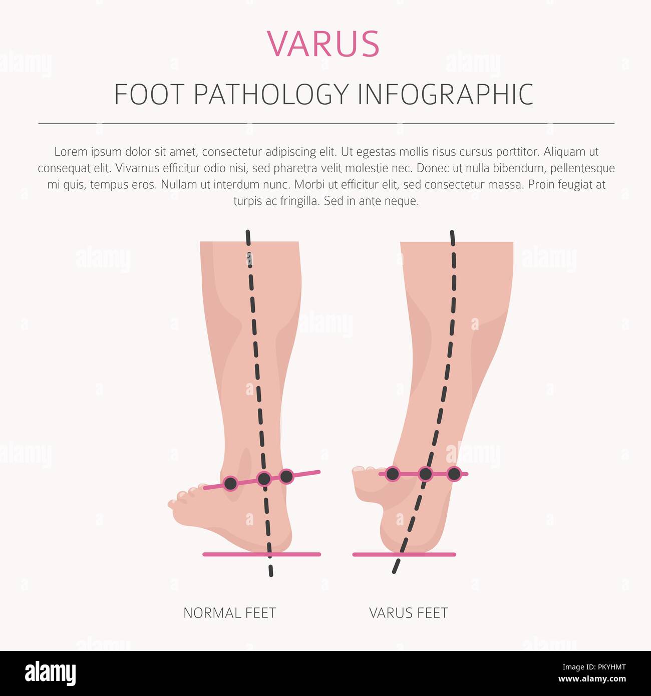 la-d-formation-du-pied-en-tant-que-maladie-m-dicale-infographie-varus