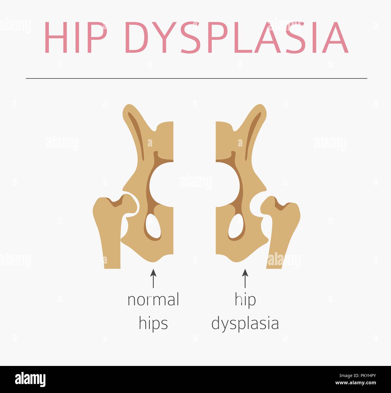 Types de déformation du pied, la maladie médicale infographie. La dysplasie de la hanche chez les enfants. Vector illustration Illustration de Vecteur