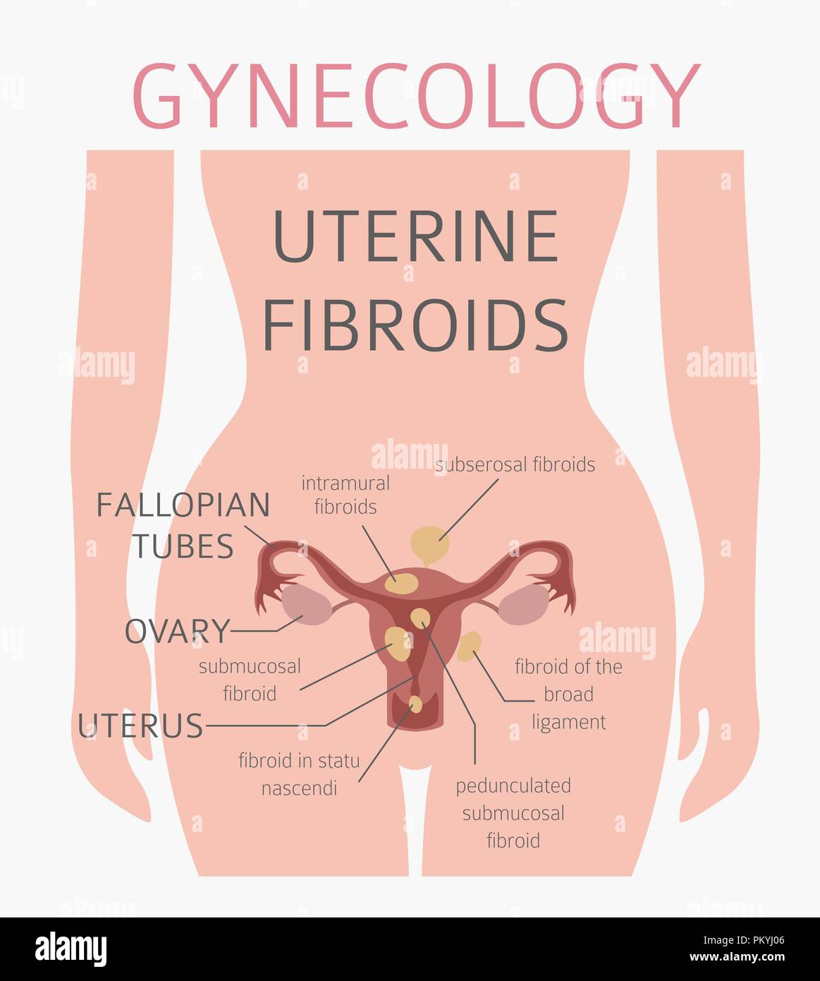 Les fibromes utérins. Ginecological maladie médicale chez les femmes infographie. Vector illustration Illustration de Vecteur