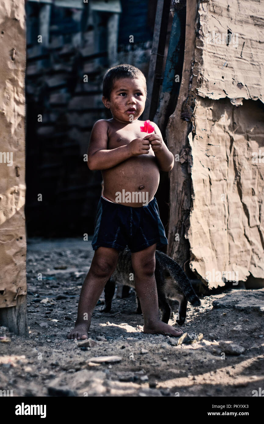 BARCELONA, VENEZUELA 2 Juin 2018 : enfant dans la communauté pauvre 'Ciudad de los mochos' avec les problèmes de malnutrition Kwashiorkor Banque D'Images