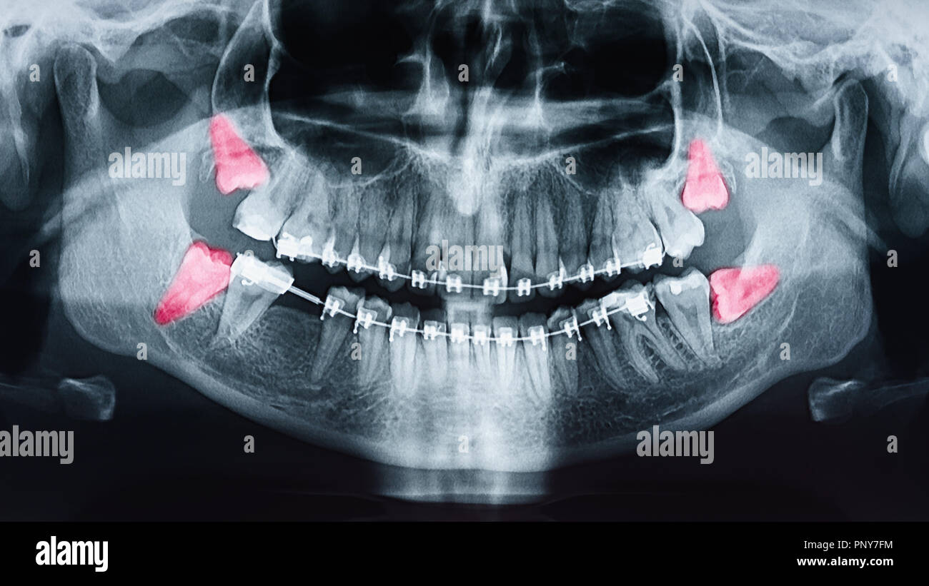 La douleur de plus en plus de dents de sagesse sur X-Ray Banque D'Images