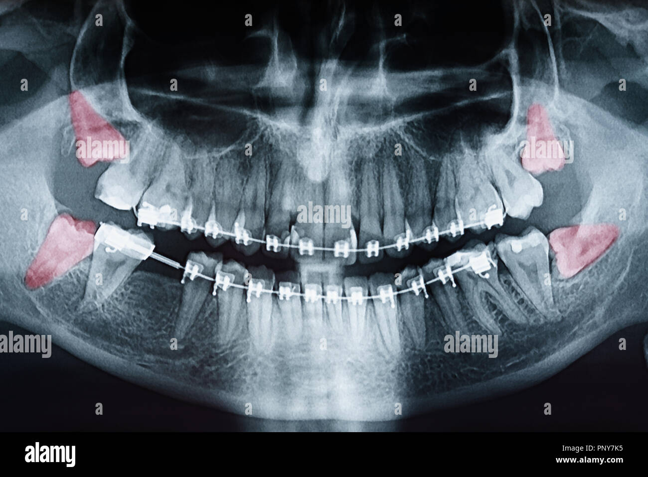 La douleur de plus en plus de dents de sagesse sur X-Ray Banque D'Images