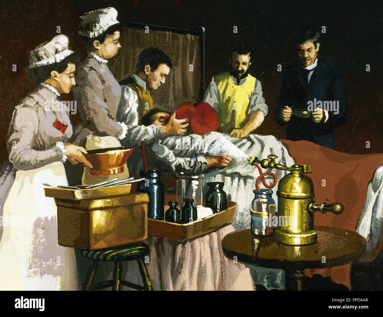 MORTON GREEN, William Thomas (1819-1868). Dentiste américain, qui a le premier utilisé avec succès en tant qu'éther anesthésique en chirurgie. Représentation d'une intervention à l'hôpital Bellevue à New York en 1870. Le