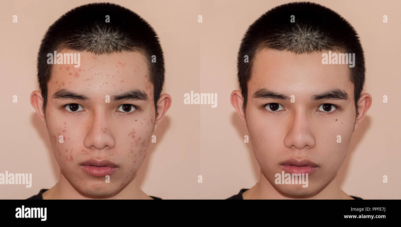 Jeune homme avec avant et après le traitement de l'acné et boutons, avant et après de traiter la peau du visage par des cicatrices et des rides par l'acné la dépose. La peau taches b Banque D'Images