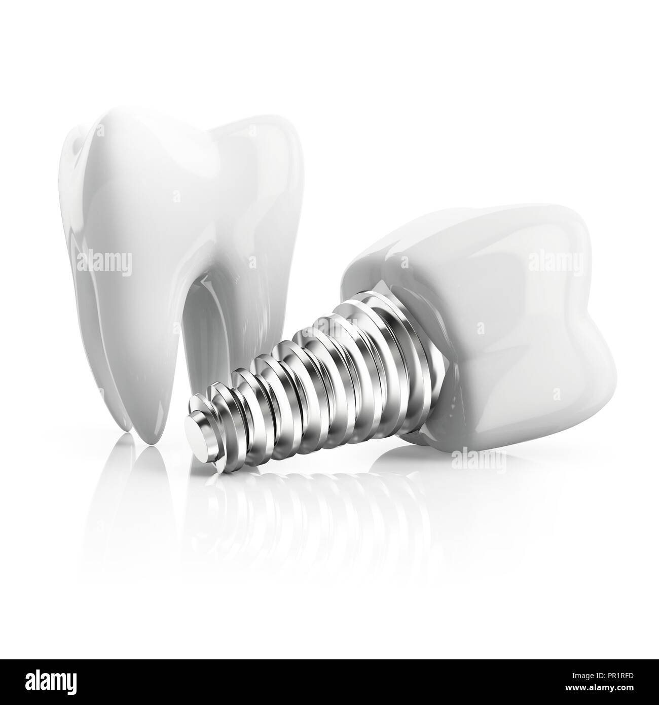 Dent avec implant, illustration. Banque D'Images