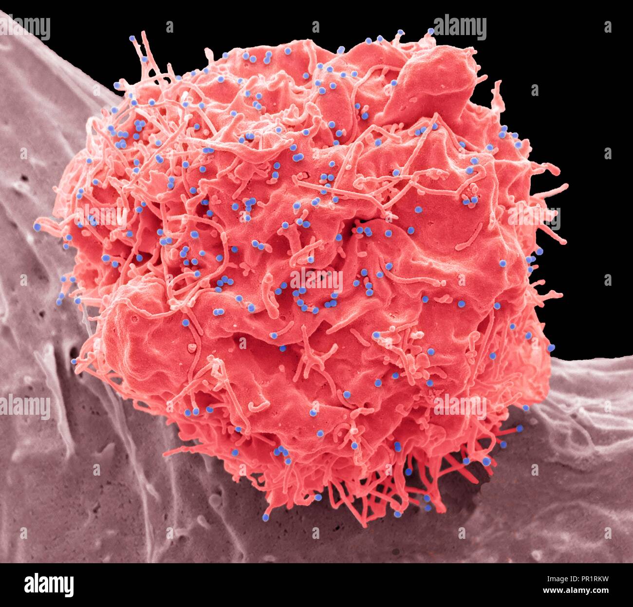 Les cellules infectées par le VIH. Couleur de l'analyse des électrons Microphotographie (SEM) d'une 293T cell infectés par le virus de l'immunodéficience humaine (VIH, points rouges). Les petites particules de virus sphérique, visible à la surface, sont dans le processus de bourgeonnement de la membrane cellulaire. Les vésicules non mis en évidence de forme irrégulière sont les exosomes, seraient impliqués dans la communication cellulaire et la transmission de la maladie, et à l'étude comme un moyen de l'administration de médicaments. Agrandissement : x6600 à 10cm de large. Modèle avec l'aimable autorisation de Greg Tours, University College London, UK. Banque D'Images