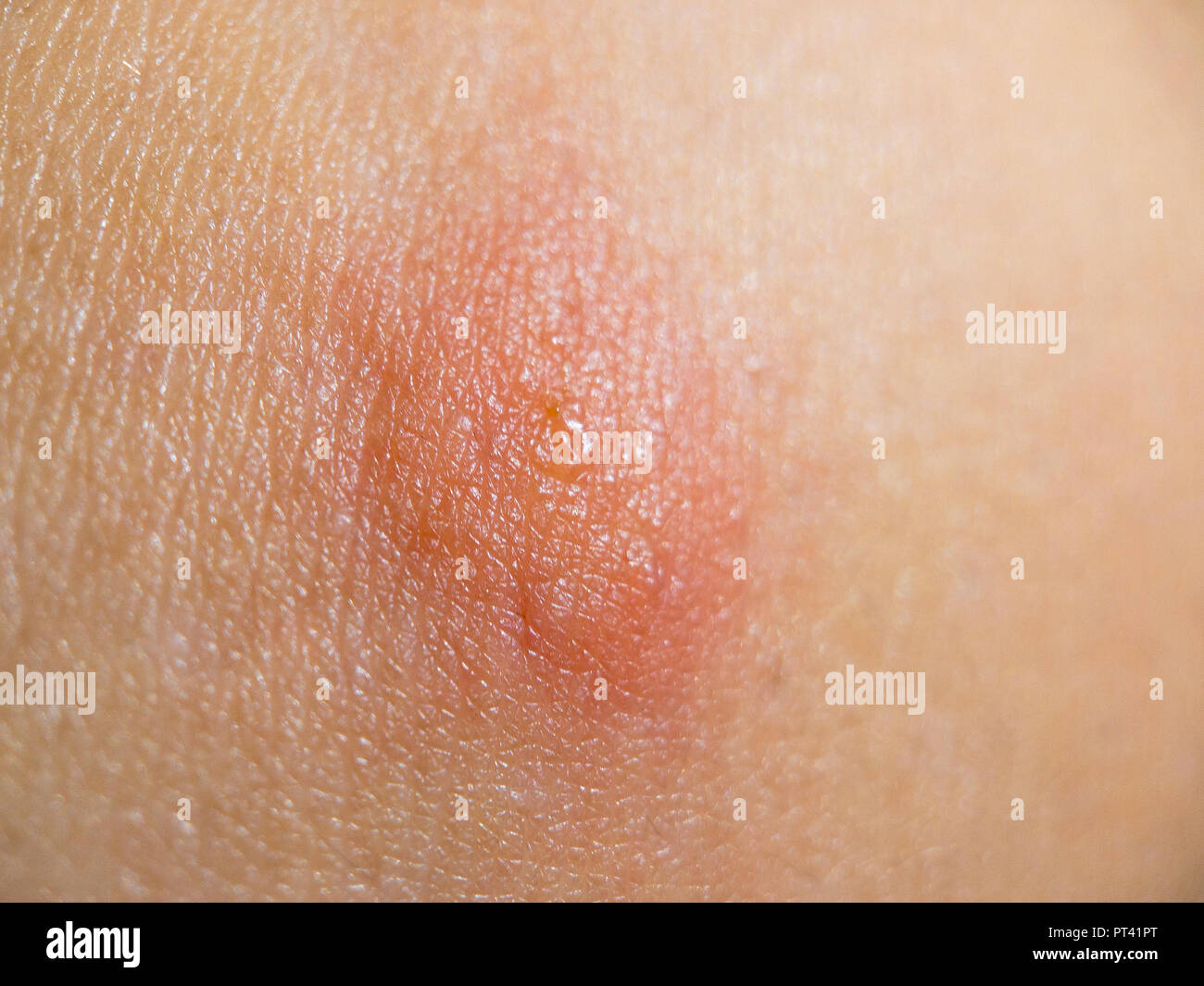 Insecte morsure sur la peau des femmes Banque D'Images