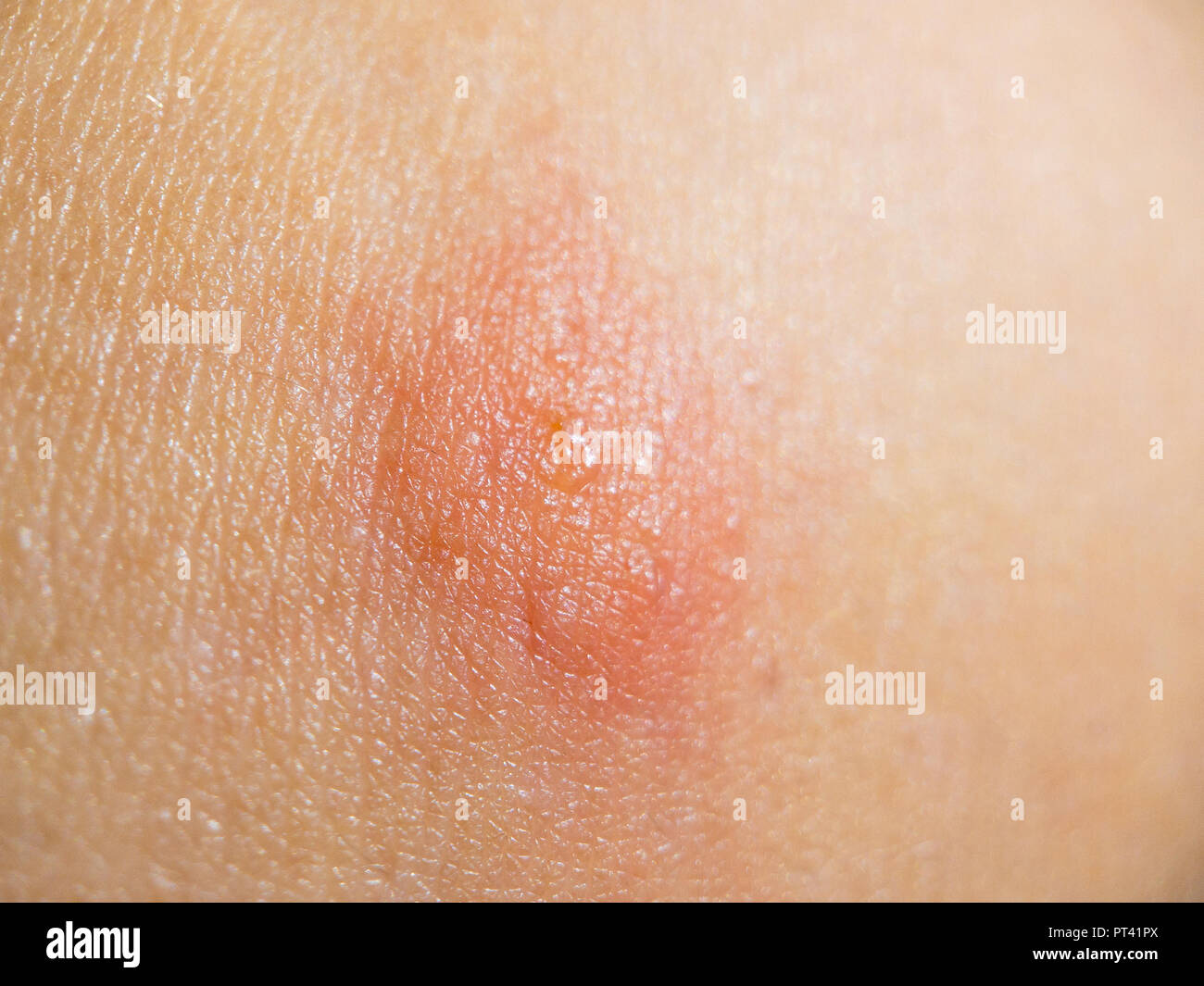 Insecte morsure sur la peau des femmes Banque D'Images