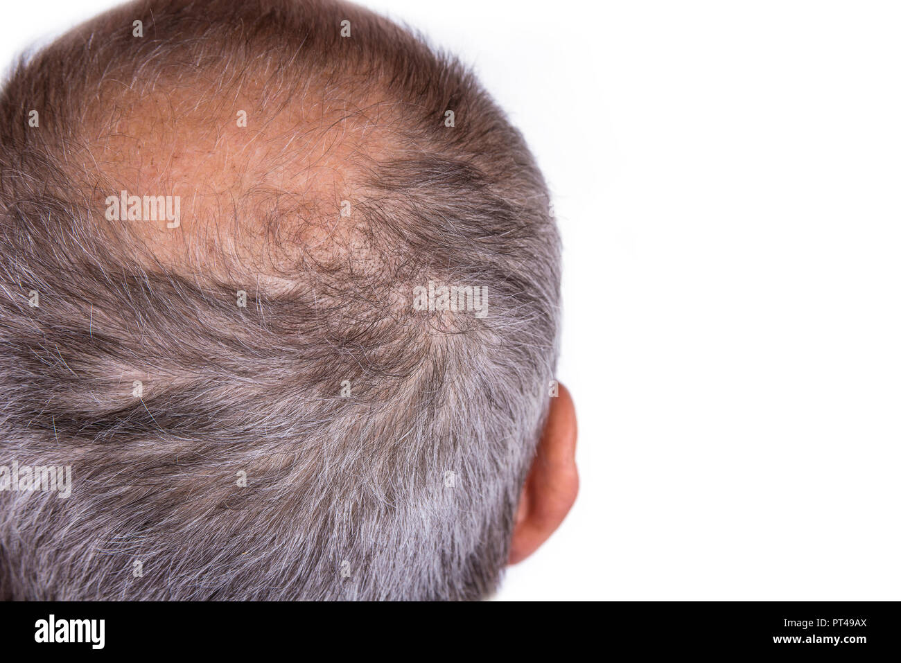 De l'homme concernés par la perte de cheveux. Concept de la Calvitie Banque D'Images