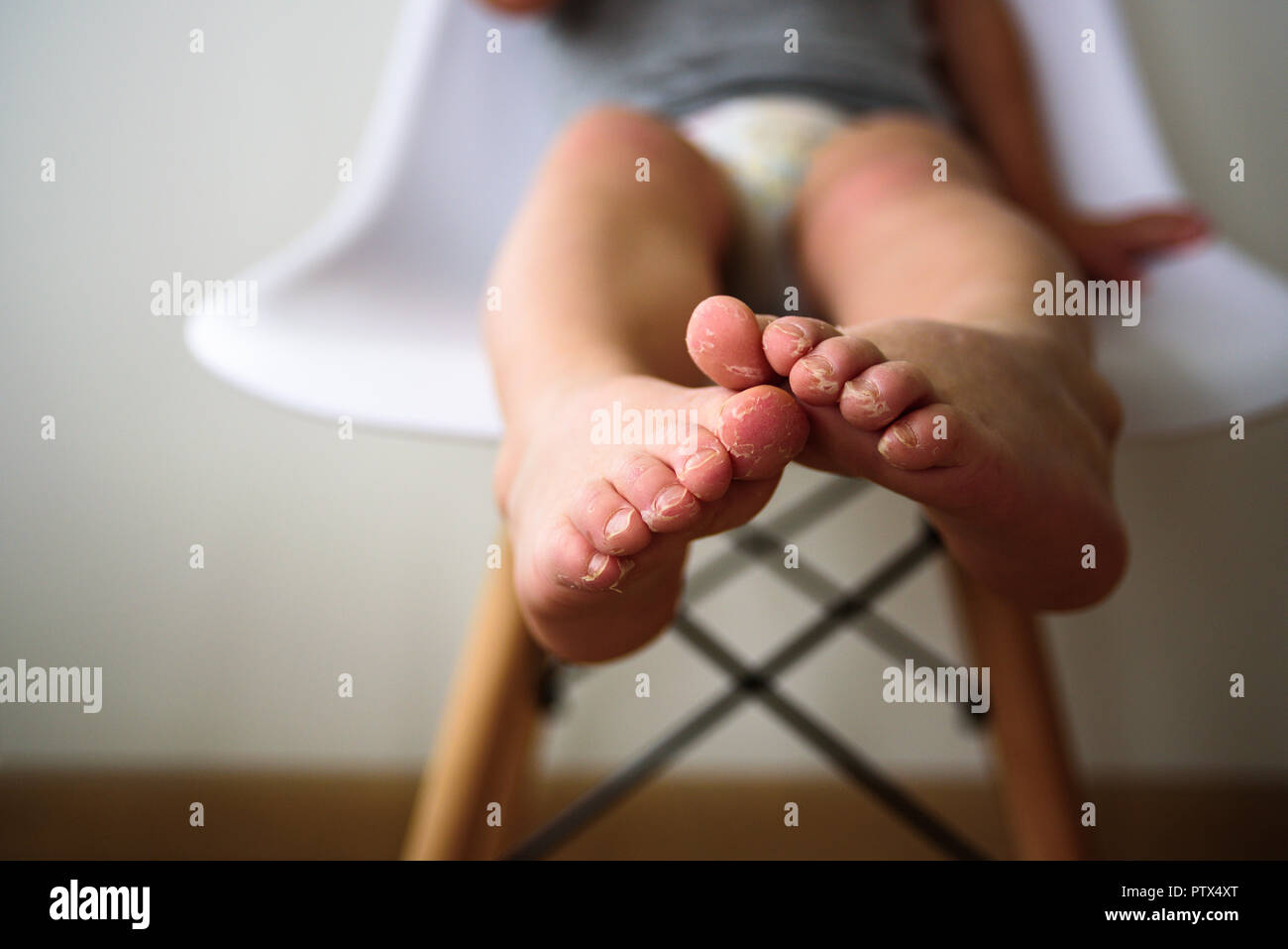 Les Jambes De Bebe Avec La Peau Floconneuse Eczema Allergie Infection A Champignon Photo Stock Alamy Les Jambes De Bebe Avec La Peau Floconneuse Eczema Allergie Infection A Champignon Photo Stock Alamy