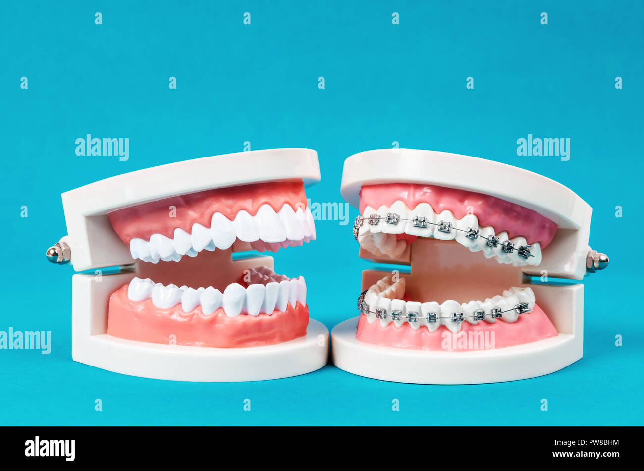 Comparer Modèle de dent et dent modèle avec fil métal appareil dentaire sur  fond bleu Photo Stock - Alamy