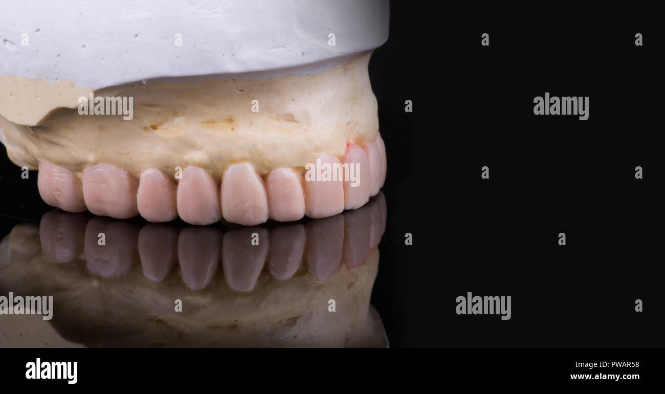 Couronnes dentaires Dents de la cire sur modèle, de métal - Vue de face avant en céramique .placages isolé sur fond noir. Couronnes sur Metal-Ceramic modèle gypse en laboratoire dentaire. Banque D'Images